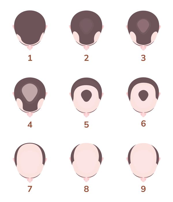 Skala som viser håravfall hos menn