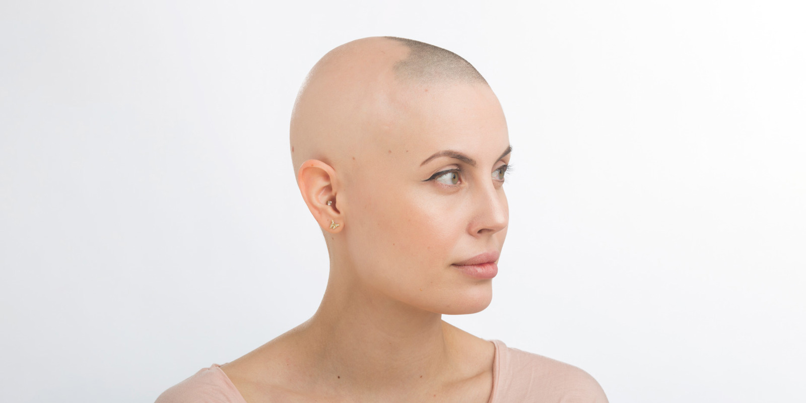 Julia har mistet håret på grunn av hudsykdommen alopeci