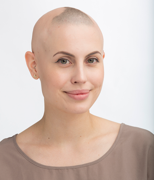 En ung kvinne med flekkvis hårtap forårsaket av alopecia areata
